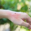 Why Mosquitoes Are So Attracted To You
