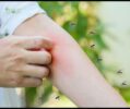 Mosquito Bites: Why Do They Prefer Some People